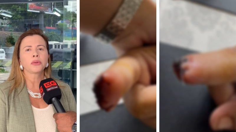 Homem arranca ponta do dedo da namorada a dentadas por ciúmes, diz advogada