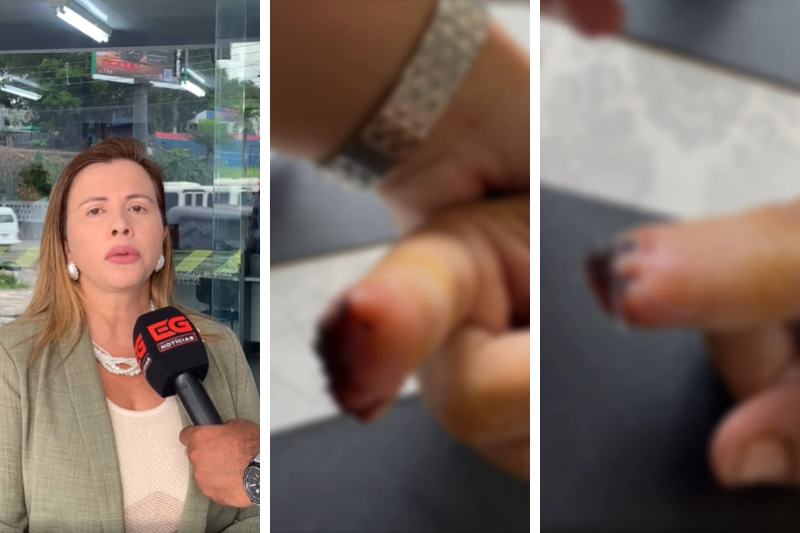 Homem arranca ponta do dedo da namorada a dentadas por ciúmes, diz advogada