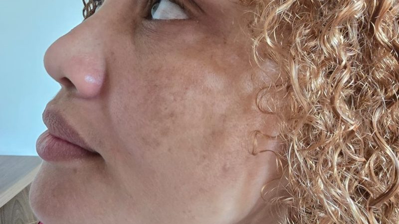 Melasma: cuidados essenciais para evitar o agravamento das manchas na pele