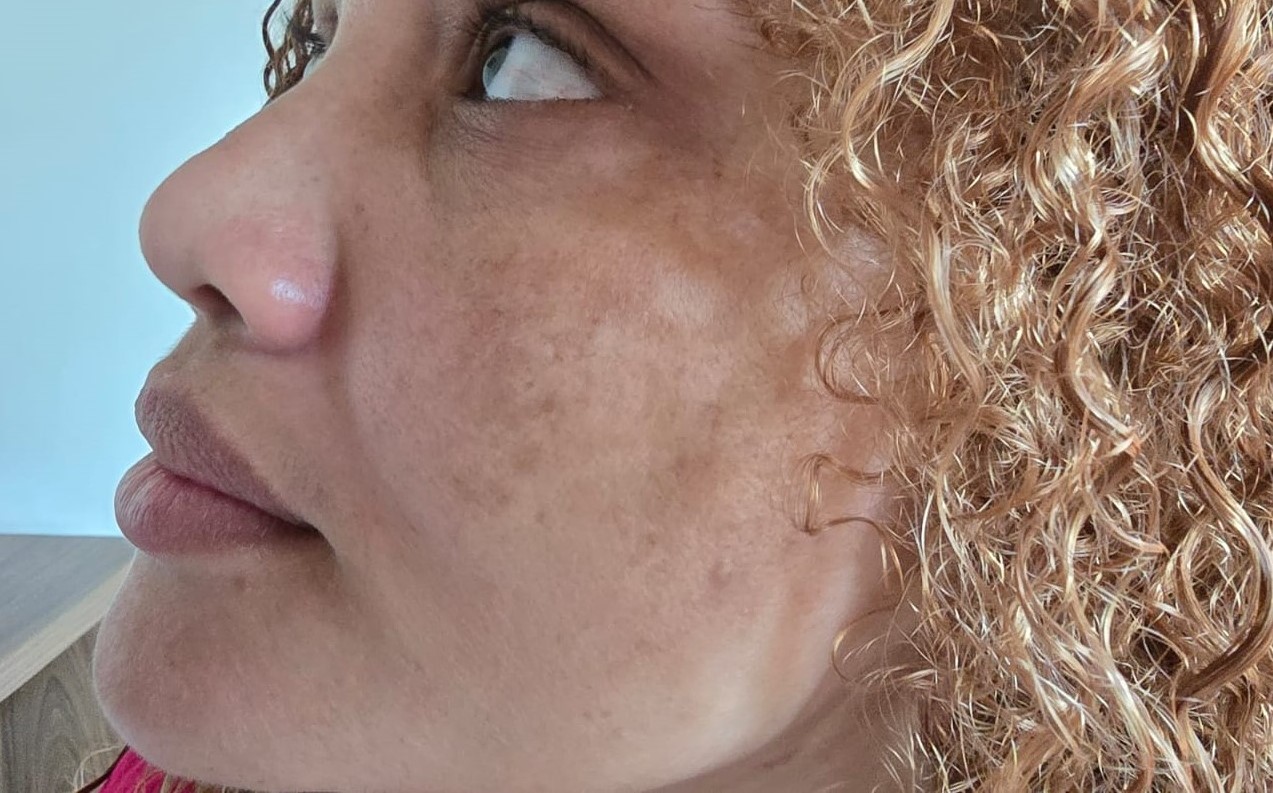 Melasma: cuidados essenciais para evitar o agravamento das manchas na pele