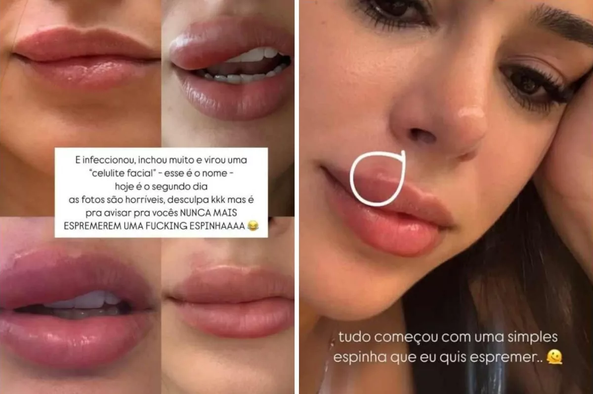 Bruna Biancardi expõe drama após infecção grave no rosto