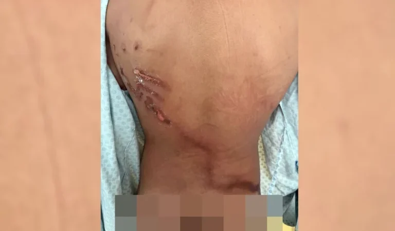 Jovem teve ferimento exposto nas costas após queda de raio do evento de Nikolas Ferreira