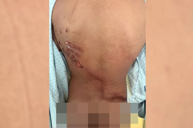 Jovem teve ferimento exposto nas costas após queda de raio do evento de Nikolas Ferreira