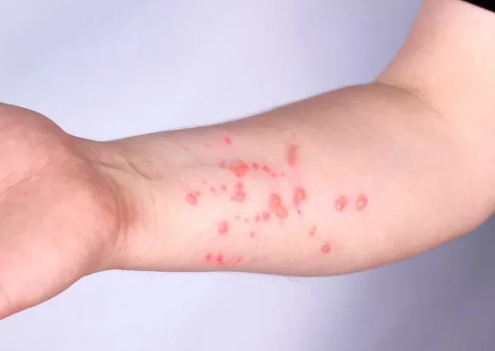 Brasil registra 88 casos de Mpox em 2026; saiba como evitar a doença