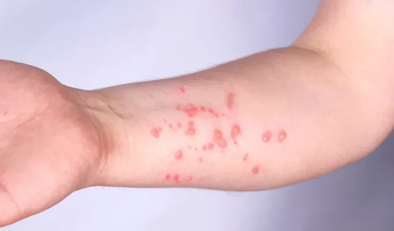 Brasil registra 88 casos de Mpox em 2026; saiba como evitar a doença