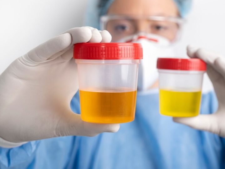 O que a cor da urina diz sobre a sua saúde e quando buscar exames médicos