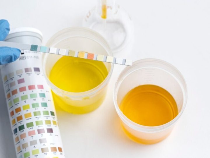 O que a cor da urina diz sobre a sua saúde e quando buscar exames médicos