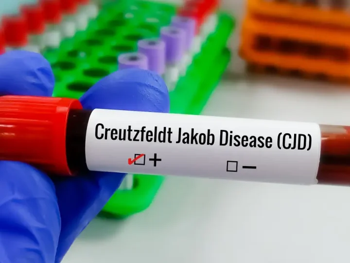 Entenda Doença de Creutzfeldt-Jakob e busca por tratamento
