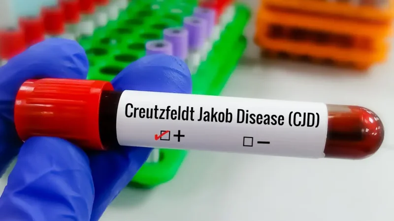 Entenda Doença de Creutzfeldt-Jakob e busca por tratamento
